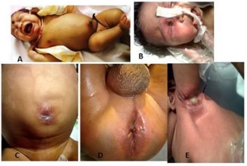 Leucocyte adhesion deficiency with multiple ulcers in a neonate
