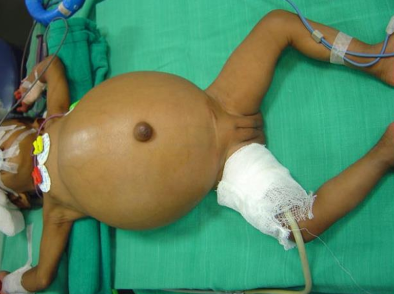 Biliary ascites due to spontaneous perforation of bile duct with pseudo choledochal cyst